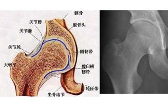 股骨头坏死保守疗法